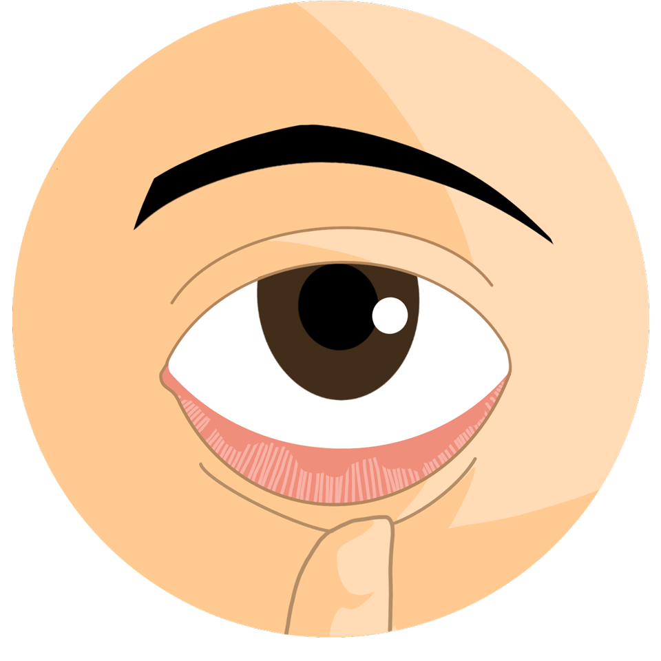 ecd_dry_eye_syndrome_lv