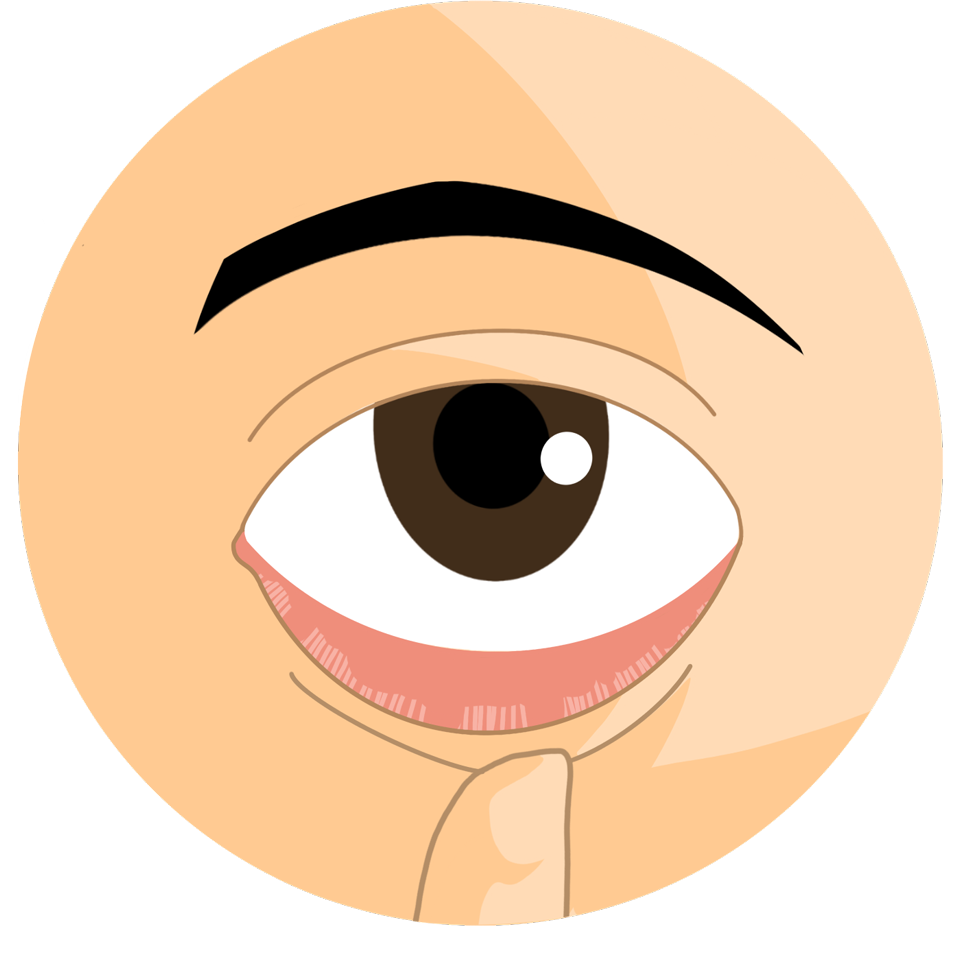 ecd_dry_eye_syndrome_lv