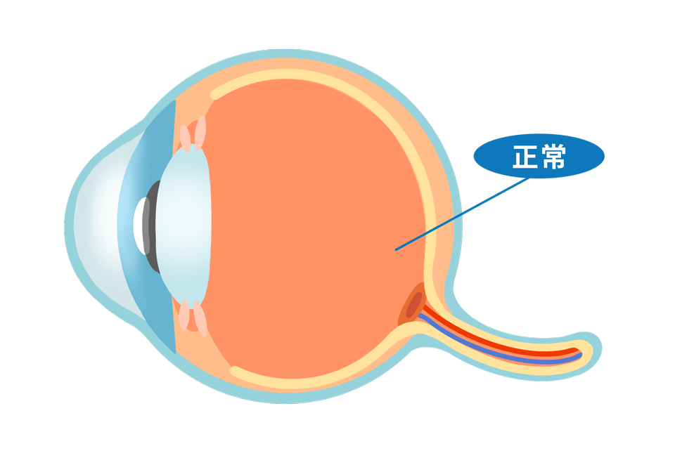 ecd_macular_degeneration_type