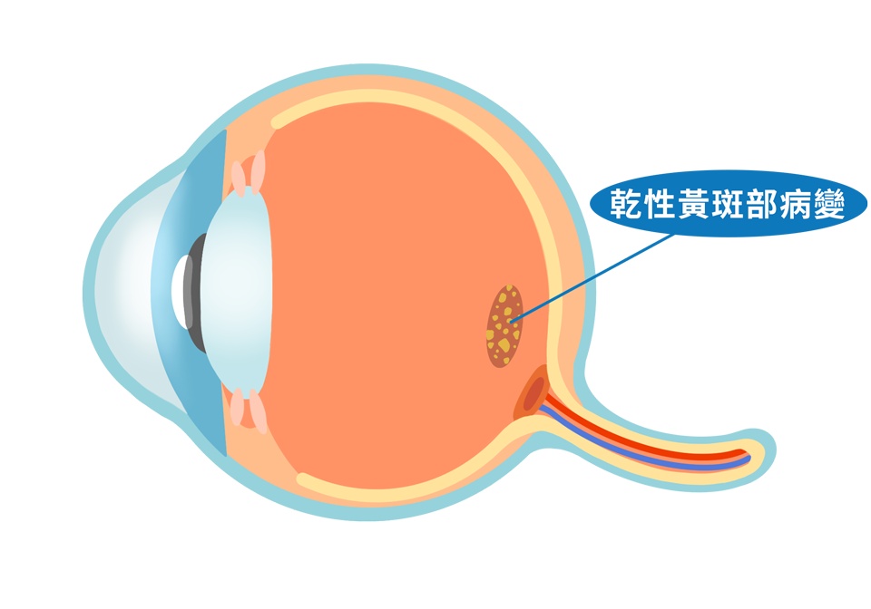 ecd_macular_degeneration_type