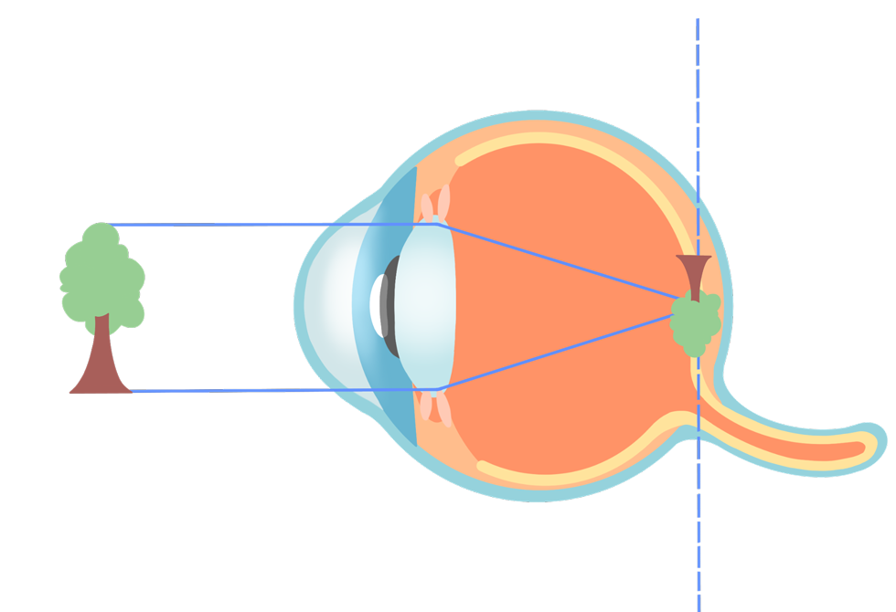 ecd_nearsighted_type