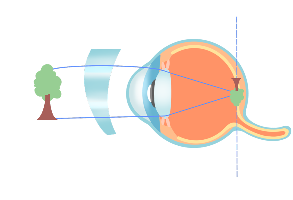 ecd_nearsighted_type